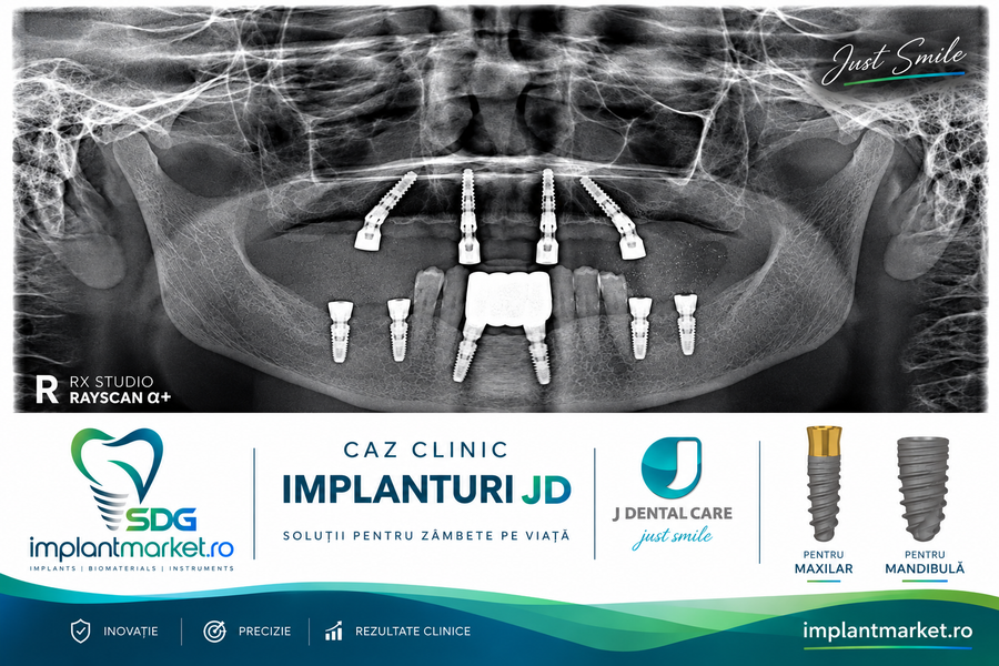 Radiografie panoramică: 4 implanturi la maxilar, cele distale angulate, și implanturi la mandibulă lângă dinții naturali
