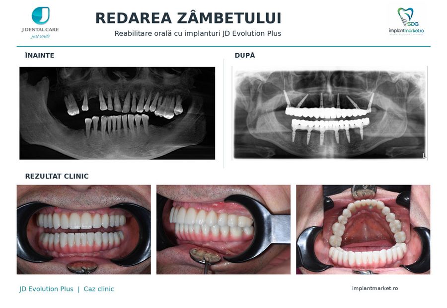 Înainte și după: reabilitare orală cu implanturi JD Evolution Plus, radiografii și fotografii intraorale