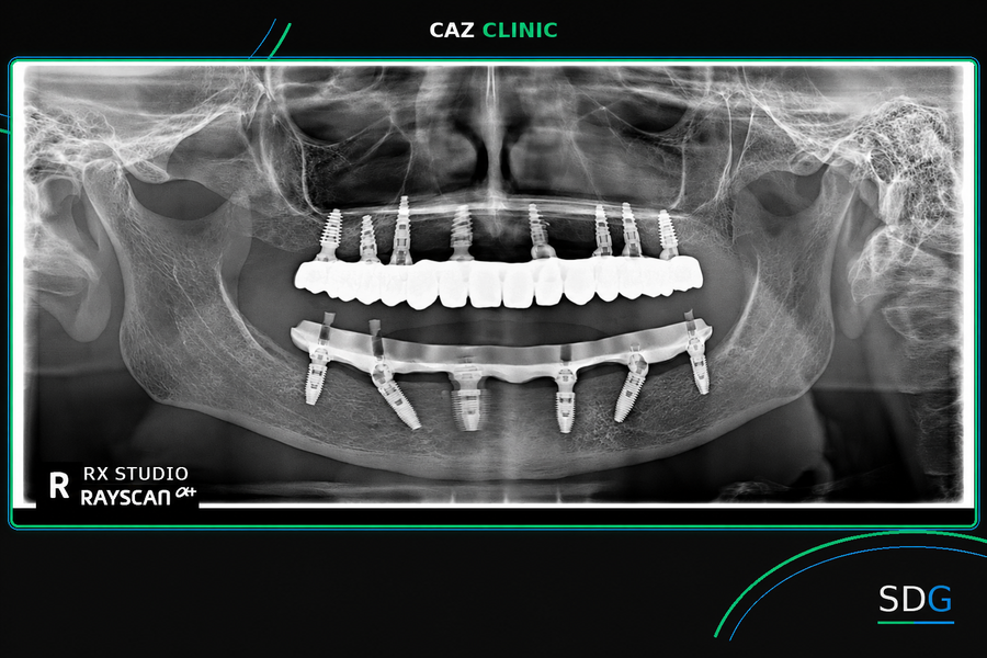 Caz clinic bimaxilar cu implanturi JD Evolution Plus, JD Icon Plus T și JD Evolution Plus T – radiografie panoramică