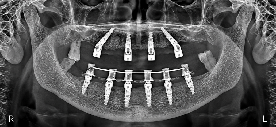 Implanturi JD Evolution Plus angulate posterior la maxilar – radiografie panoramică, caz bimaxilar