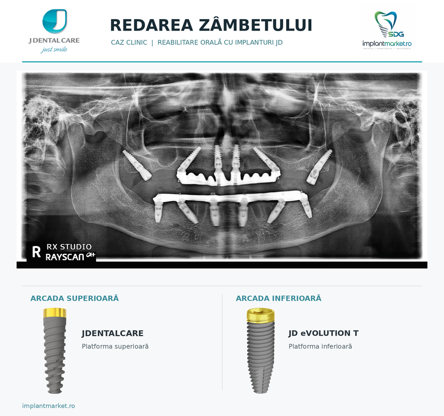 Implanturi pterigoidiene distal la maxilar și lucrări fixe pe implanturi pe ambele arcade – radiografie panoramică