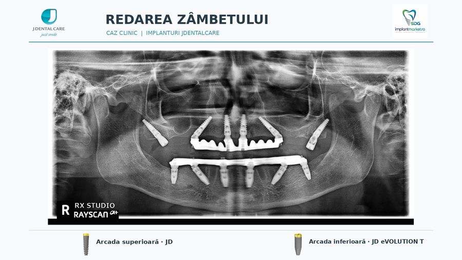 Radiografie panoramică: implanturi JD Evolution Plus și pterigoidiene la maxilar, JD Evolution Plus T la mandibulă