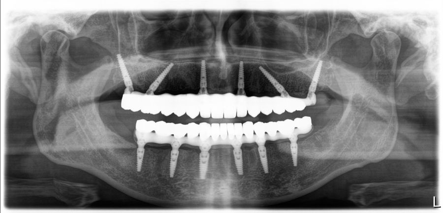 Radiografie panoramică: lucrări fixe pe câte 6 implanturi JD Evolution Plus la maxilar și la mandibulă